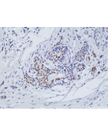 Immunohistochemical staining of formalin fixed and paraffin embedded human breast cancer tissue sections using Anti-ER-alpha Rabbit Monoclonal Antibody (Clone RM292) at a 1:100 dilution.