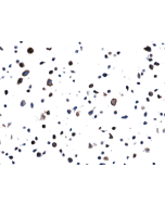 Immunohistochemical staining of formalin fixed and paraffin embedded H1975 cell section using Anti-EGFR(L858R) Rabbit Monoclonal Antibody (Clone RM380) at a 1:100 dilution.